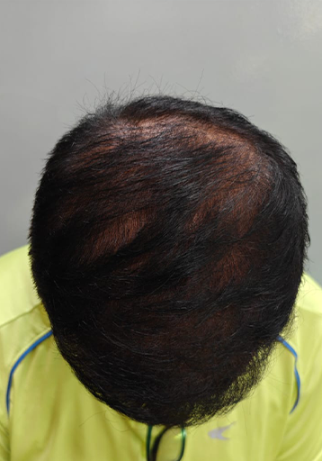 After — Rohan V., FUE, 3,200 grafts
