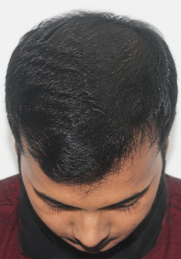 After — Adarsh Singh, DHI, frontal hairline