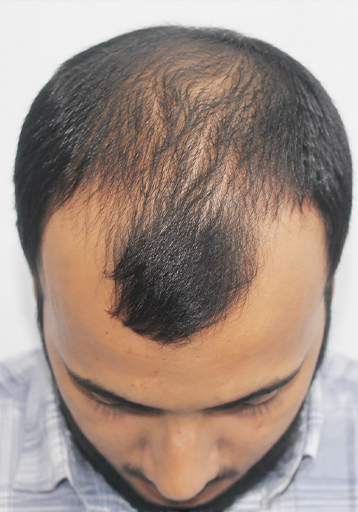 Before — Adarsh Singh