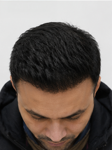 After — Amit P., FUT, 4,800 grafts